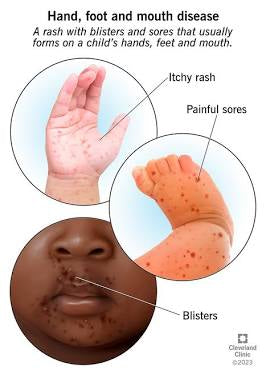 Eczema & HFM Kits