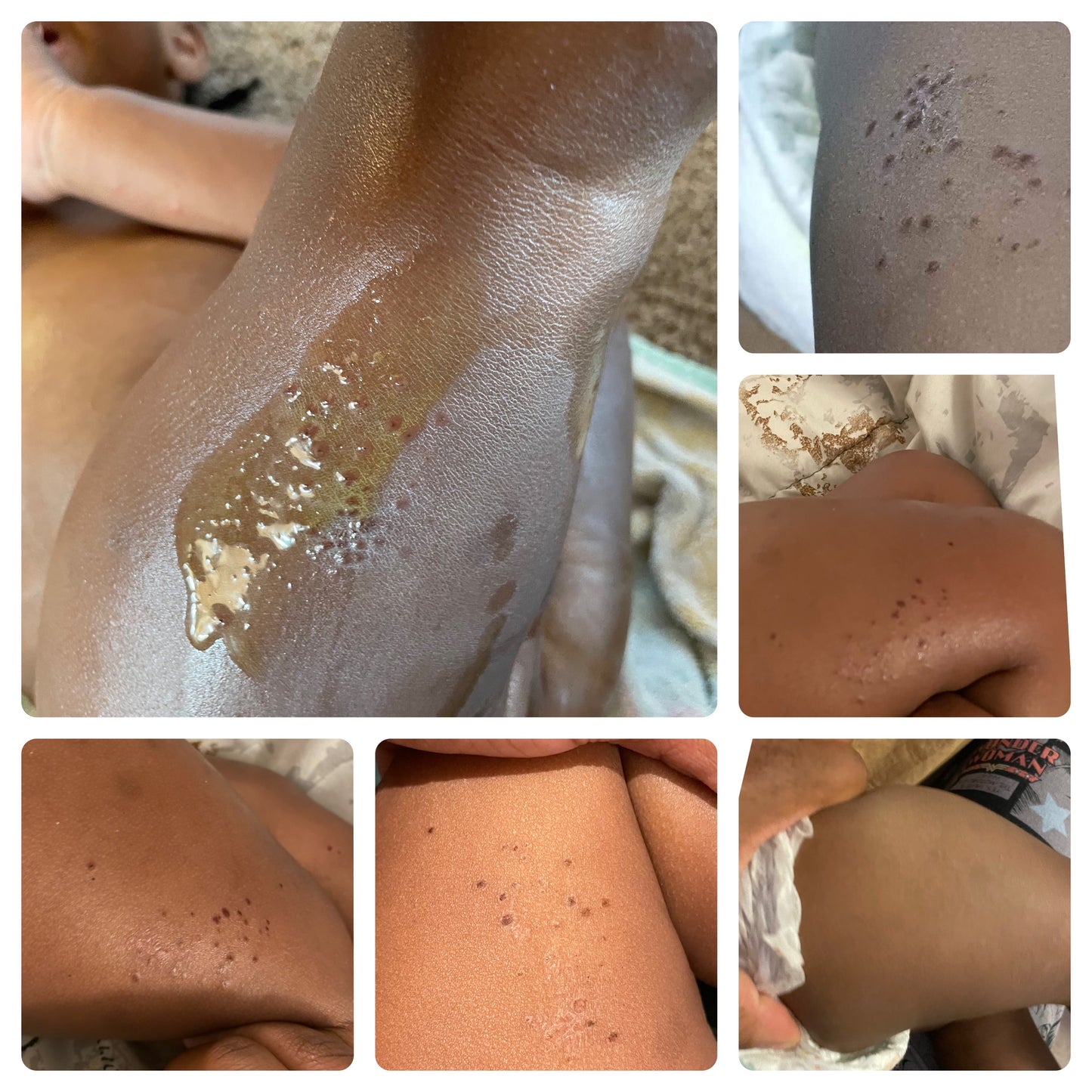 Eczema & HFM Kits
